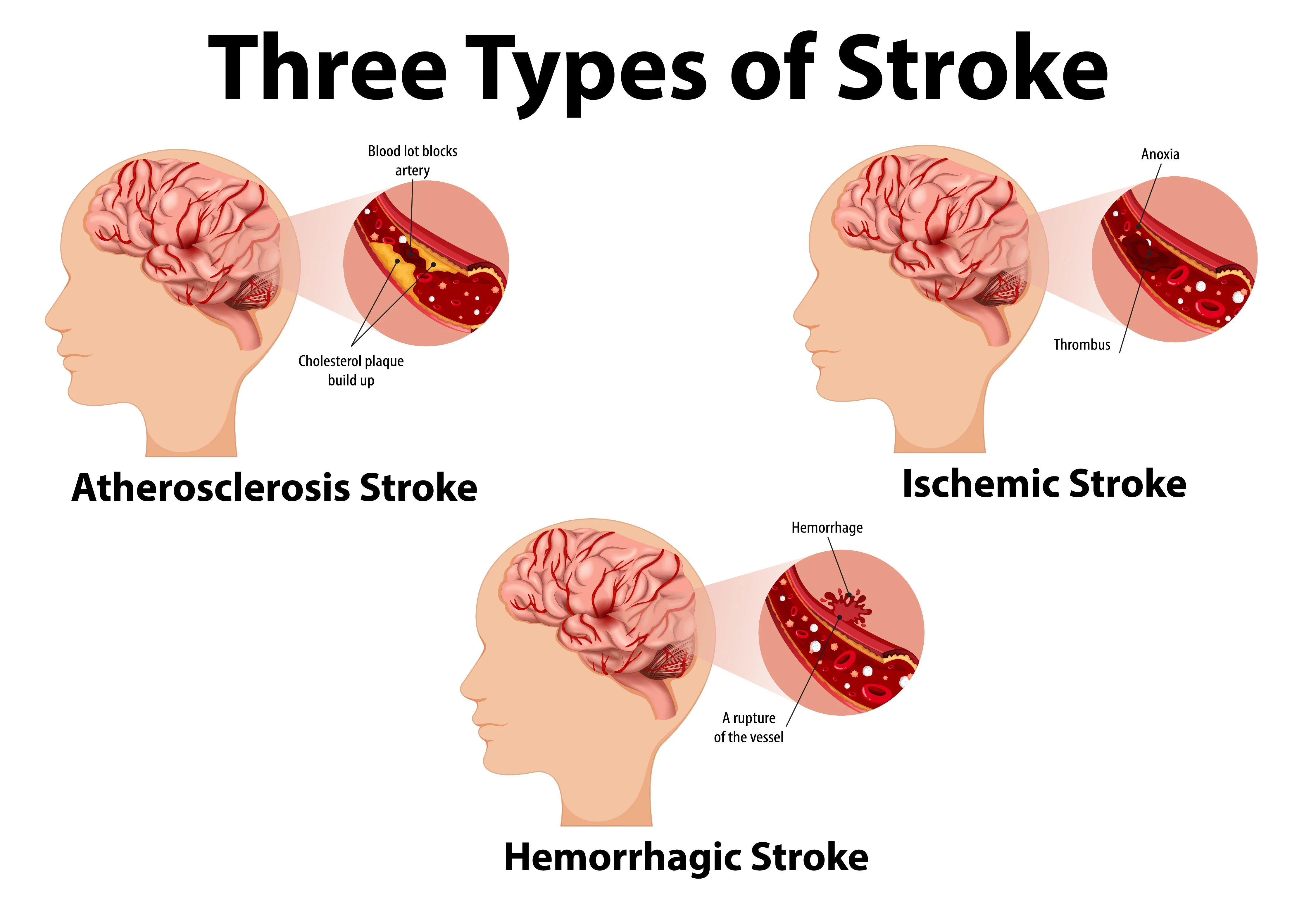 Brain Stroke Treatment Hospital – Emergency Care